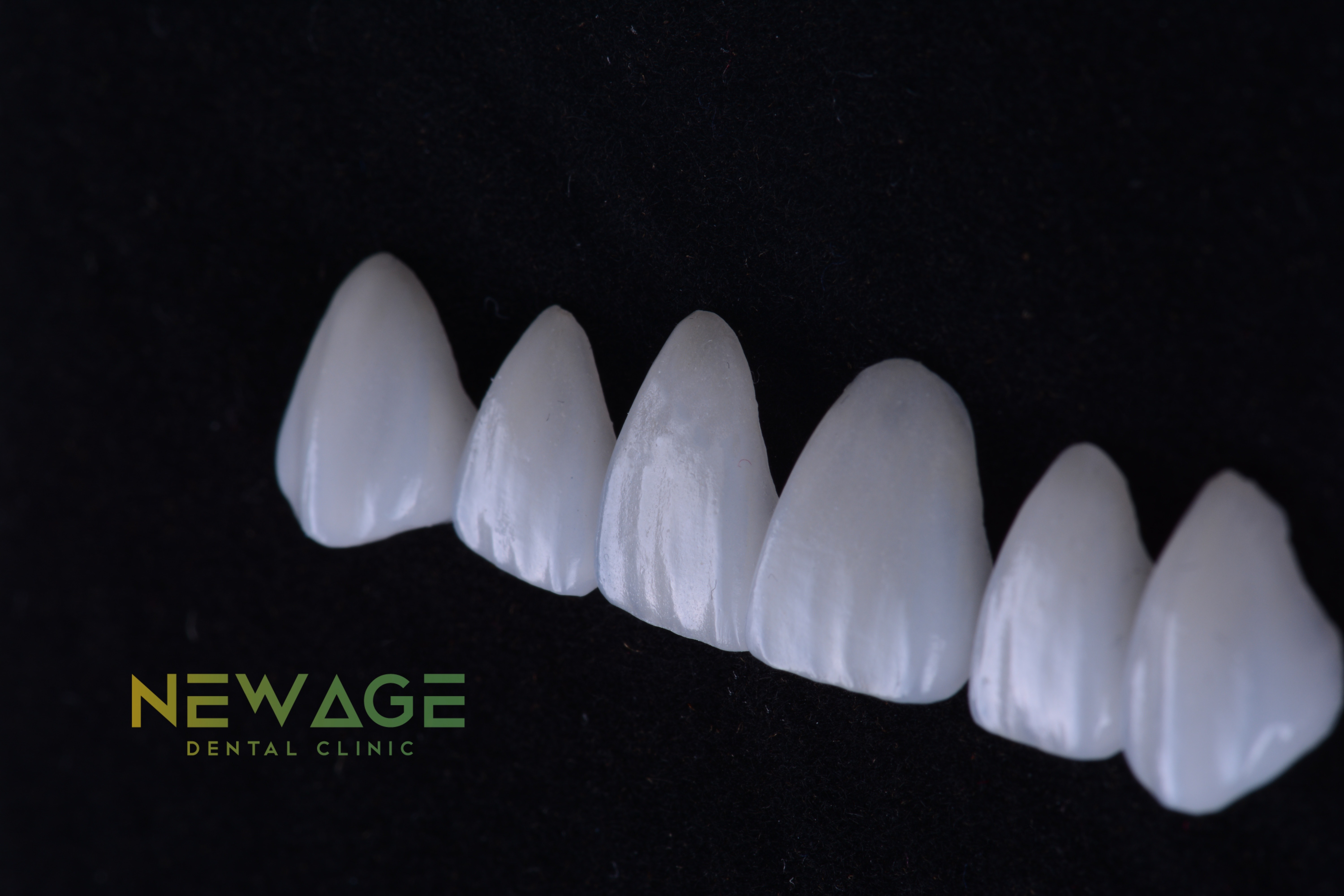 Questions About Dental Veneers in Tijuana